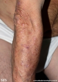 Cutaneous T-cell_lymphoma