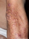 Cutaneous T-cell_lymphoma