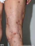 Cutaneous T-cell_lymphoma