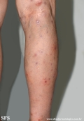 Cutaneous T-cell_lymphoma