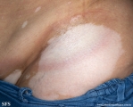 vitiligo_and_morphea