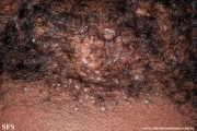 folliculitis cheloidalis