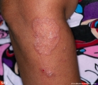 tinea corporis