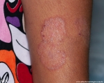 tinea corporis