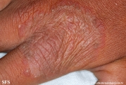 tinea manuum