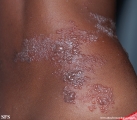 herpes zoster