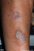psoriasis
