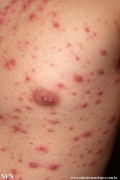varicella