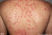 varicella