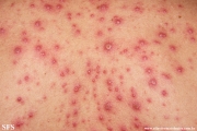 varicella