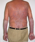 psoriasis