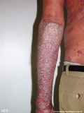 psoriasis