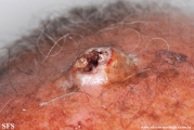 squamous cell carcinoma