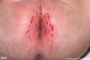 perianal streptococcal dermatitis