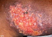 sporotrichosis