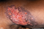 sporotrichosis