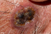 squamous cell carcinoma