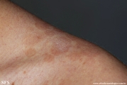 pityriasis versicolor