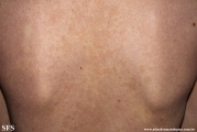 pityriasis versicolor