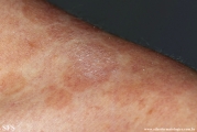 pityriasis versicolor