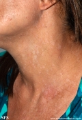 pityriasis versicolor