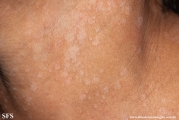 pityriasis versicolor