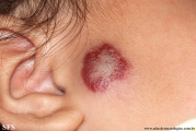 haemangioma