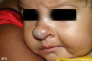 haemangioma