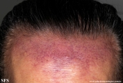 secondary_cutaneos_b-cell_lymphoma
