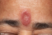 facial_granuloma