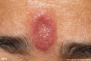 facial_granuloma