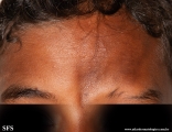 scleroderma-frontoparietal_morphoea