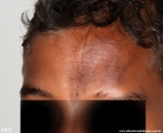 scleroderma-frontoparietal_morphoea