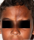 scleroderma-frontoparietal_morphoea