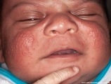 acne neonatorum