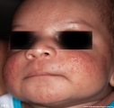 acne neonatorum