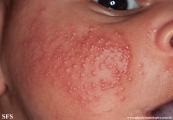 acne neonatorum