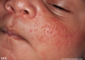 acne neonatorum