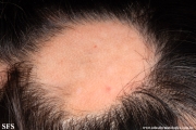 alopecia areata