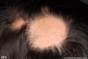 alopecia areata
