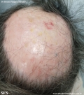 alopecia areata