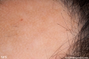 alopecia areata