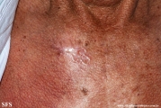 basal cell carcinoma
