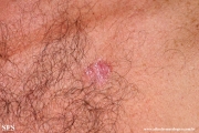 basal cell carcinoma