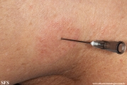 leprosy tuberculoid