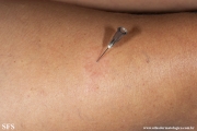 leprosy tuberculoid