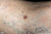 pinkus_fibroepithelioma
