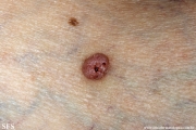 pinkus_fibroepithelioma