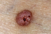 pinkus_fibroepithelioma