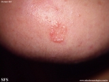 trichoepithelioma dermoplastic